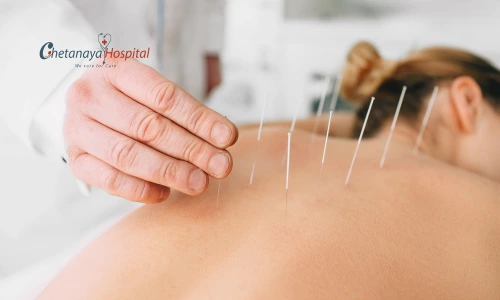 Acupuncture